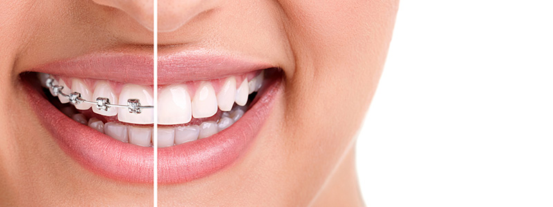 Ortodontik Tedavi Yöntemleri